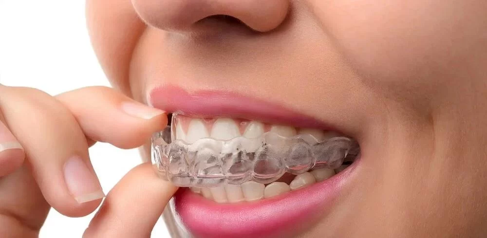 How to Fix a Gap Between Your Teeth Without Braces - Natural Solutions and Tips