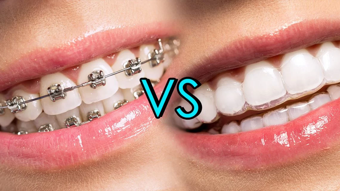 Invisalign vs Traditional Braces: Which One is Right for You?