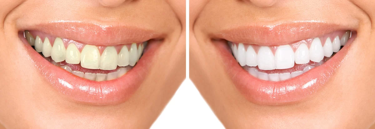 Why You Should Consider Teeth Whitening Before a Big Event: Get That Perfect Smile