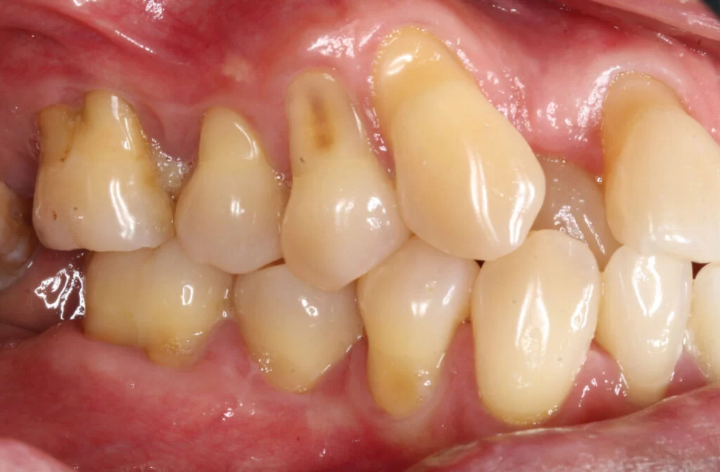 What Causes Gums to Recede and How to Prevent It: Essential Tips for Healthy Gums