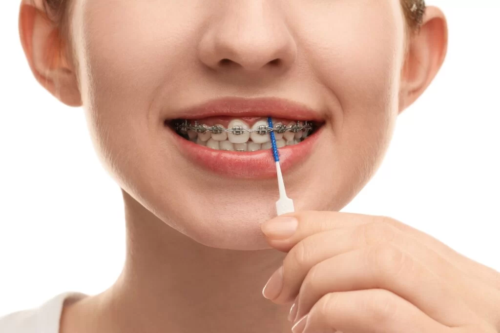 How to Care for Your Teeth After Getting Braces - Essential Tips & Guide
