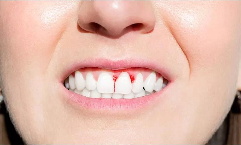 Why Do Your Gums Bleed When Brushing Your Teeth? Common Causes and How to Prevent It