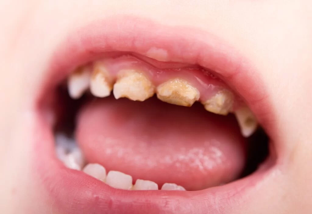 How to Prevent Cavities in Your Toddler’s First Teeth: Essential Tips for Parents