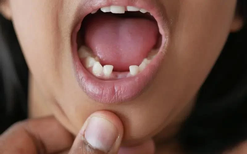 How to Handle a Knocked-Out Tooth After a Dental Injury: A Comprehensive Guide