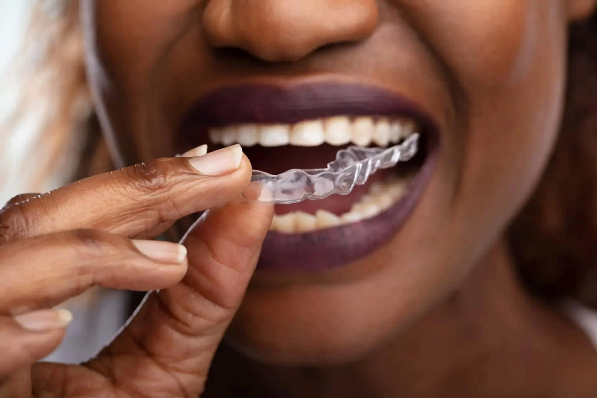 How to Stop Grinding Your Teeth at Night: Effective Solutions for Bruxism