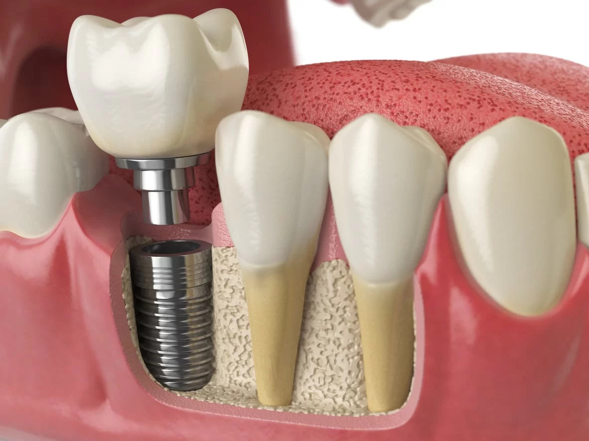 What to Expect from a Dental Implant Procedure: A Complete Guide