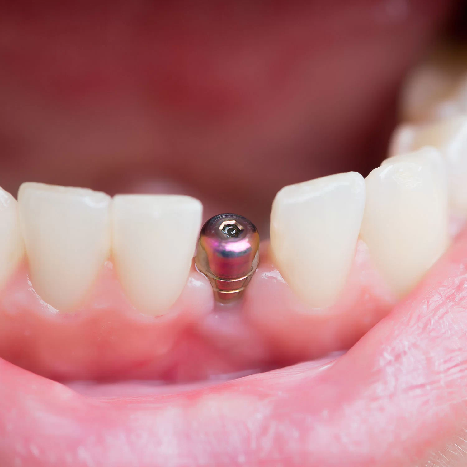 How Long Do Dental Implants Take to Heal? A Complete Guide to the Healing Process