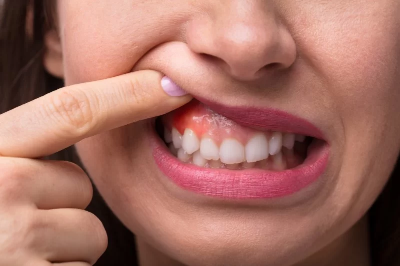 Best Treatments for Gum Inflammation: Effective Solutions for Relief and Healing