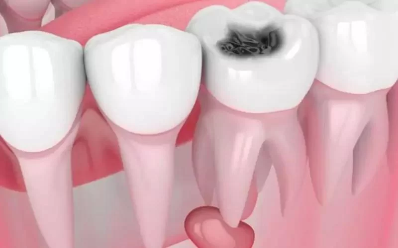 Signs of Tooth Infection and When to See a Dentist: A Complete Guide