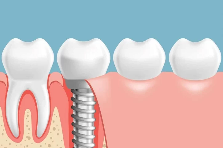 Dental Implants vs Partial Dentures: A Detailed Comparison of Two Popular Dental Solutions