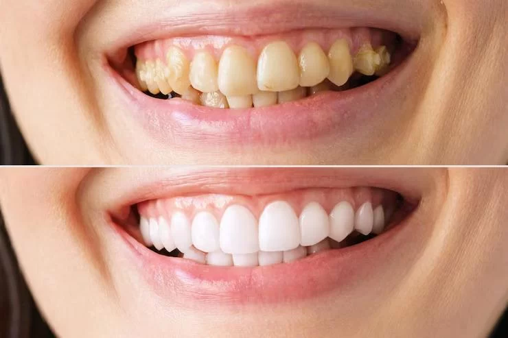 Smile Restoration: Transform Your Smile with the Best Dental Solutions