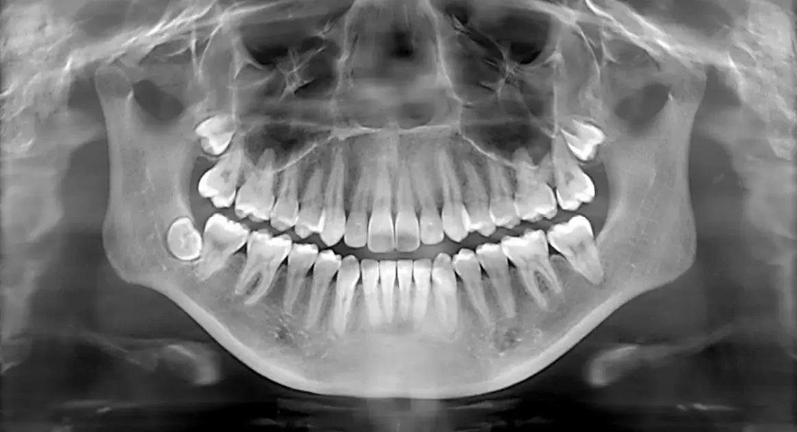 Dental X-Rays: Everything You Need to Know About This Essential Dental Diagnostic Tool