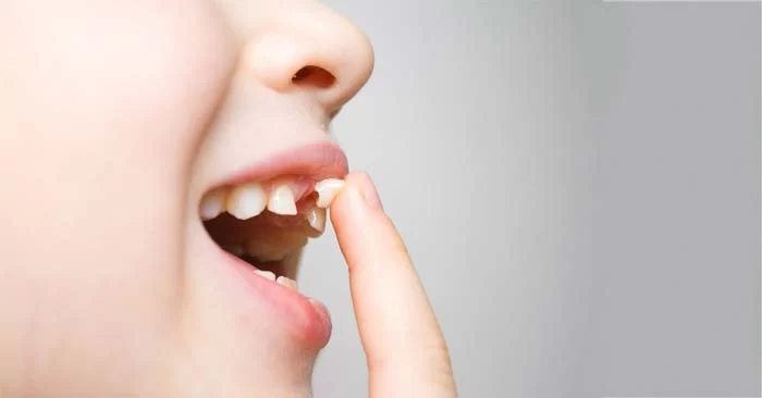 What to Do If Your Tooth Is Loose: A Guide to Caring for Loose Teeth
