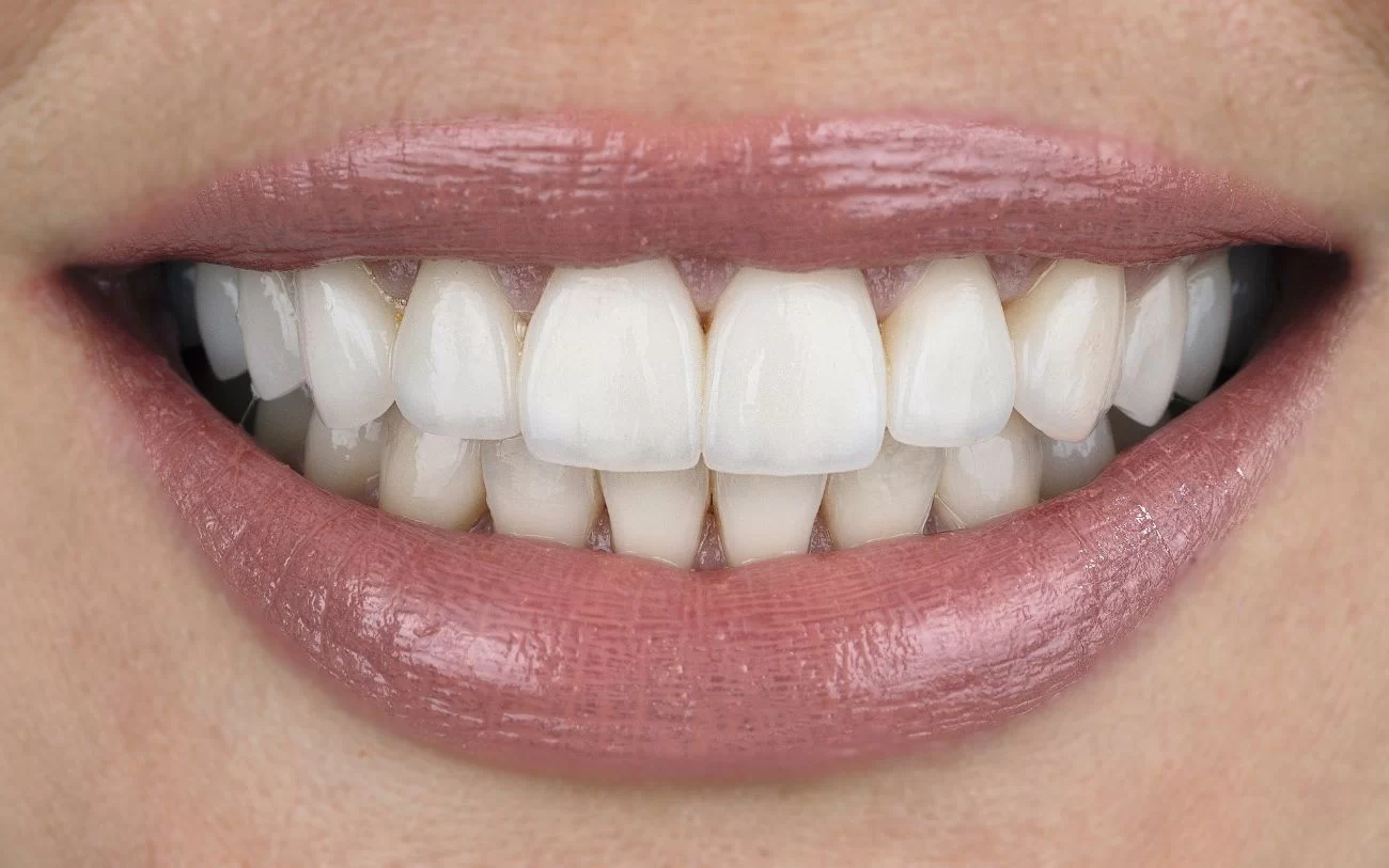 Can Veneers Be Used to Fix Crooked Teeth? A Comprehensive Guide