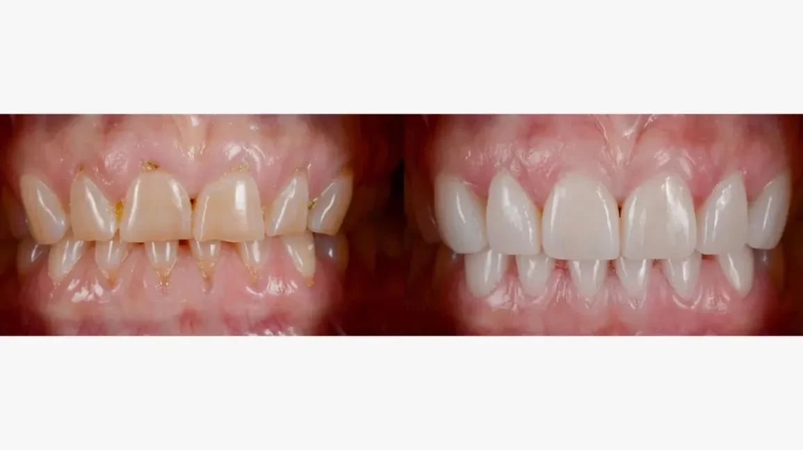 Dental Veneers Fitting: A Comprehensive Guide to the Procedure and Benefits