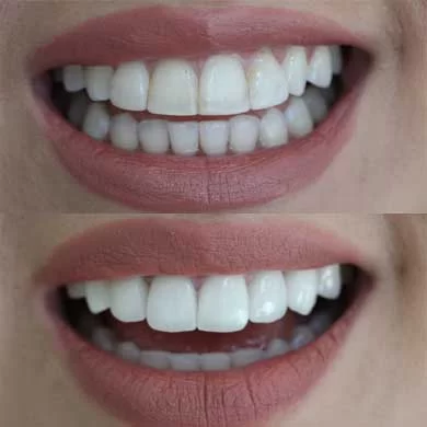 Dental Bonding vs. Veneers: What’s the Difference? A Complete Guide