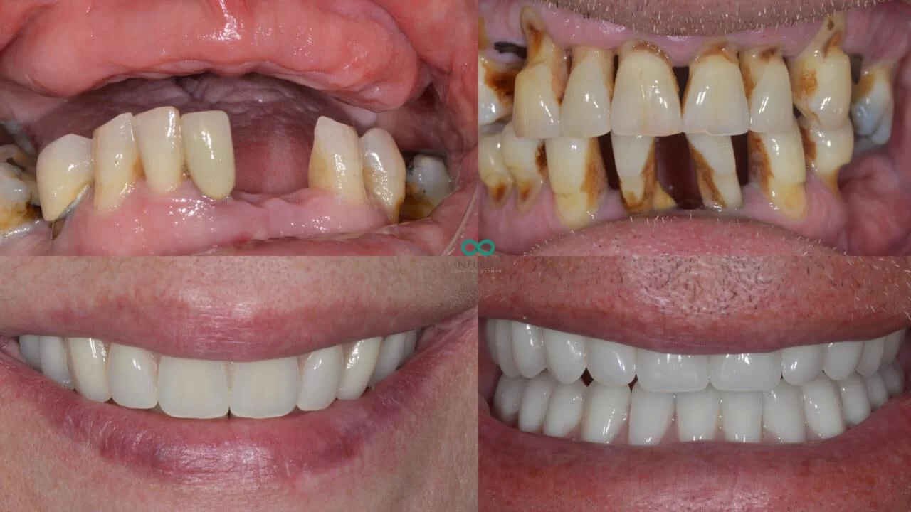 Dental Implants vs Dentures: What’s the Best Option for Your Smile?