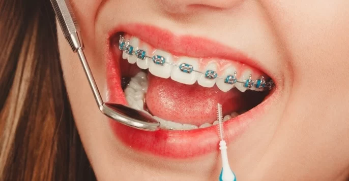 How to Maintain Your Oral Health During Orthodontic Treatment: Tips for Healthy Teeth with Braces