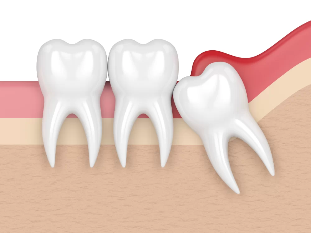What Are the Symptoms of an Infected Wisdom Tooth? Signs and Treatment