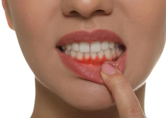 Can Diabetes Cause Tooth and Gum Problems? Understanding the Impact on Oral Health