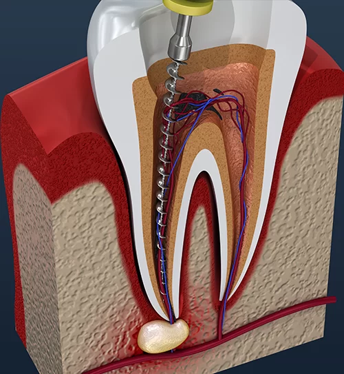 Does a Root Canal Always Mean a Tooth is Lost? Understanding the Root Canal Process
