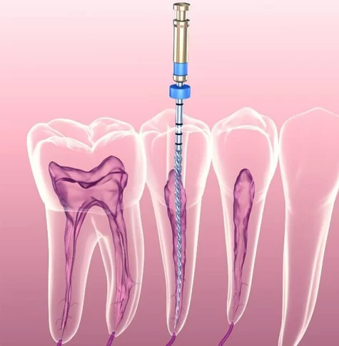 Can Root Canal Treatment Cure an Infected Tooth? Understanding the Process and Benefits