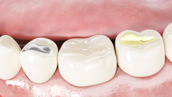 What to Know About Dental Fillings for Cavities: Types, Procedures, and Options