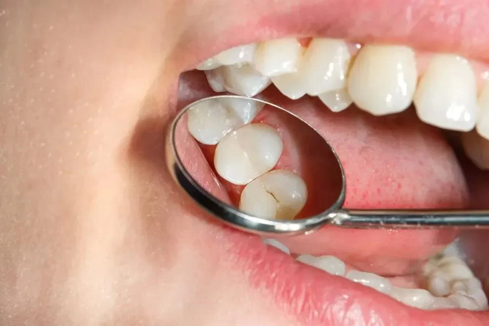 How to Effectively Treat a Cavity in a Molar Tooth: Complete Guide
