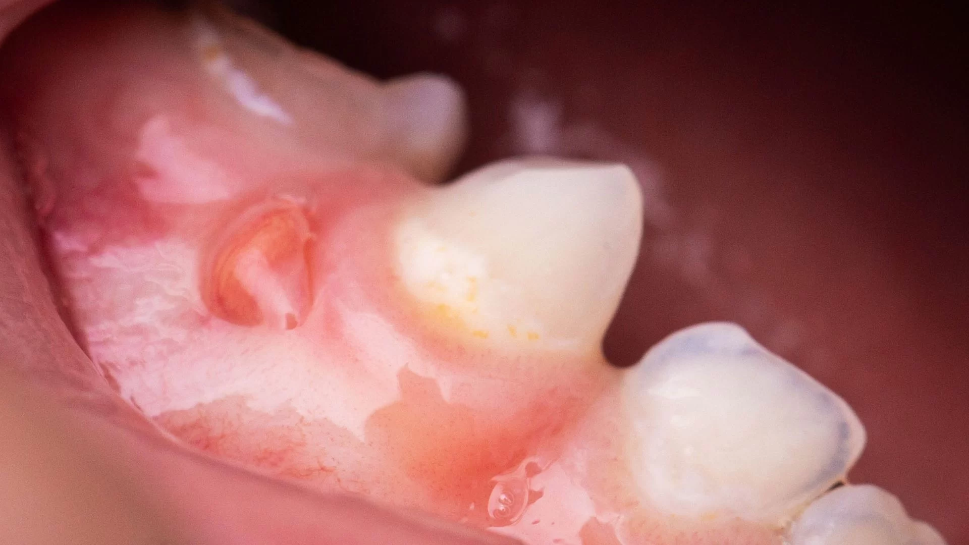 How to Deal with a Swollen Gum Around a Tooth: Causes and Effective Remedies