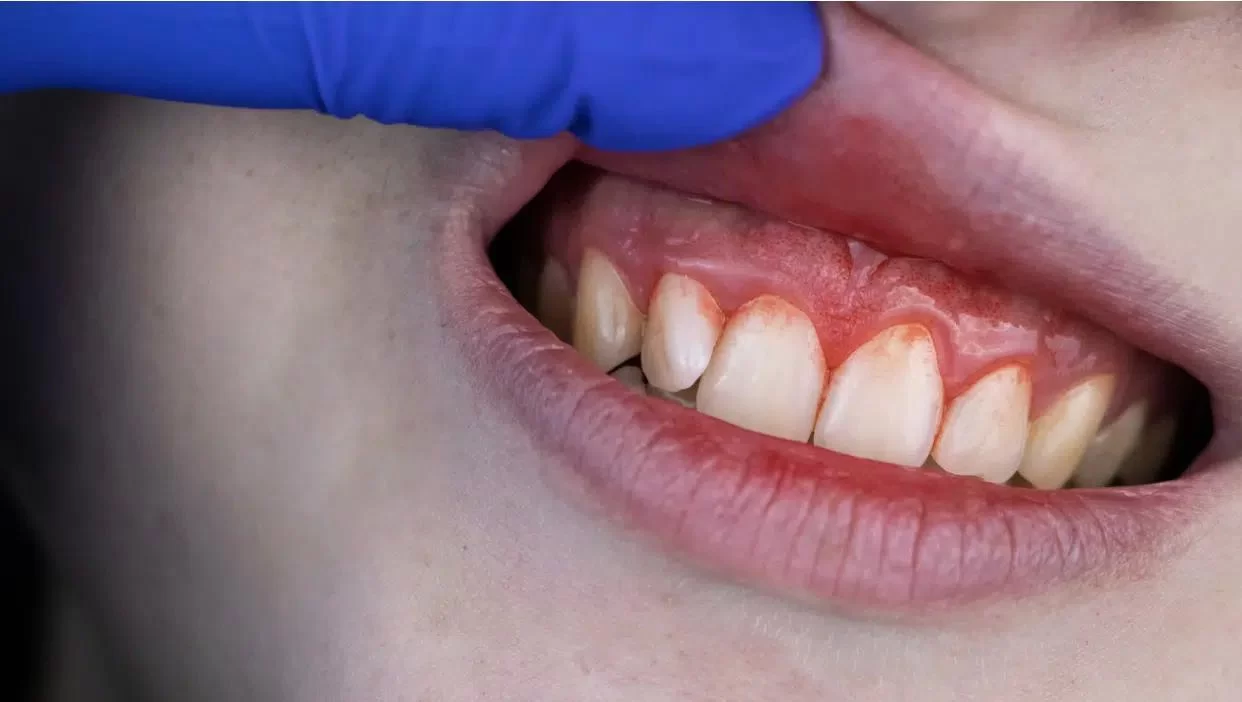 How to Treat an Inflamed Gum Line: Effective Remedies and Tips