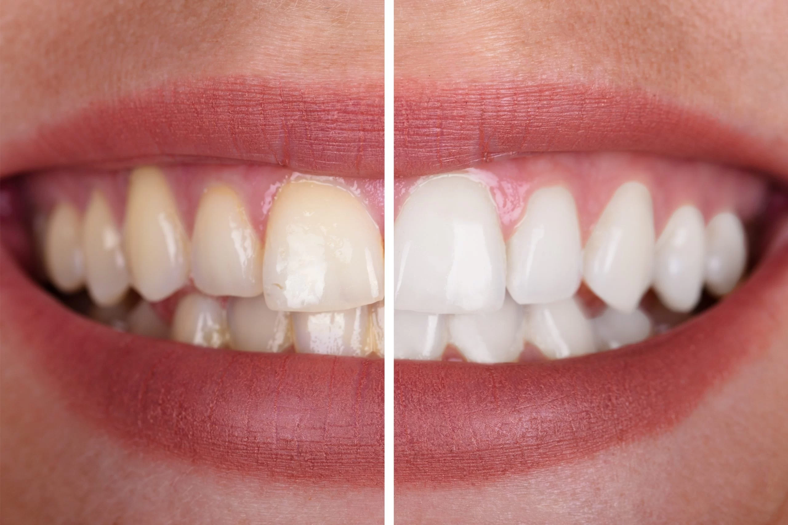 Can Teeth Whitening Damage My Enamel? Understanding Risks and Safety