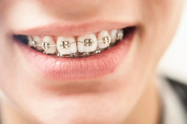 Understanding the Dental Orthodontic Process: What You Need to Know