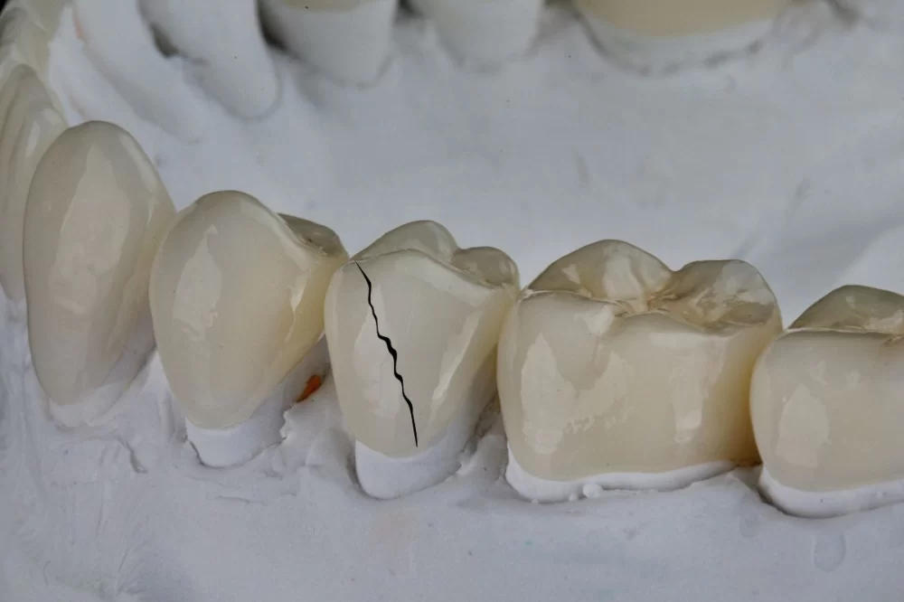 How to Handle a Broken Dental Crown Until Your Appointment