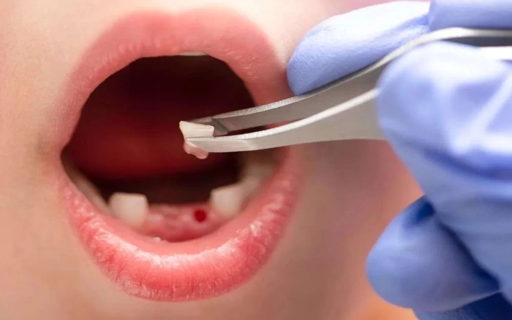 How to Stop Dental Bleeding After an Injury: A Step-by-Step Guide