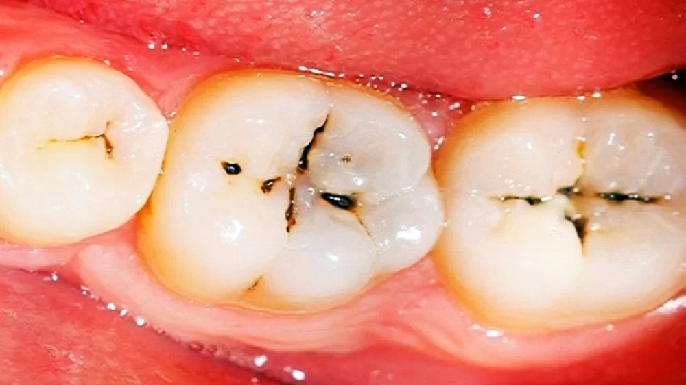 Signs That You Have a Cavity and Need to See a Dentist