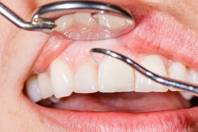 How to Treat Gum Recession and Prevent It – Effective Solutions for Healthy Gums