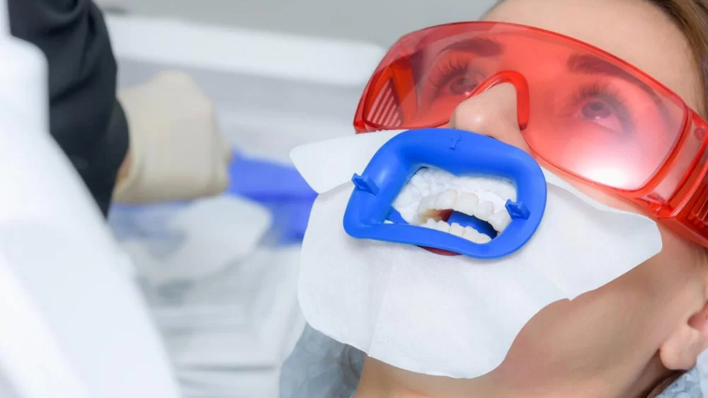 How to Treat Sensitive Teeth After Whitening: Effective Tips for Relief