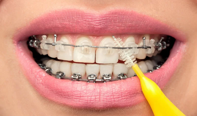 How to Prevent Food from Getting Stuck in Your Braces: Essential Tips for Braces Care
