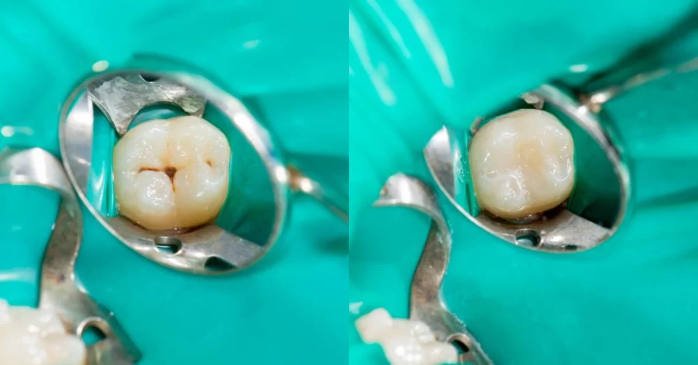 Understanding the Different Types of Tooth Fillings and Their Benefits