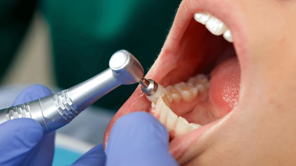 The Benefits of Routine Professional Dental Cleanings: Why Regular Dental Cleanings Matter
