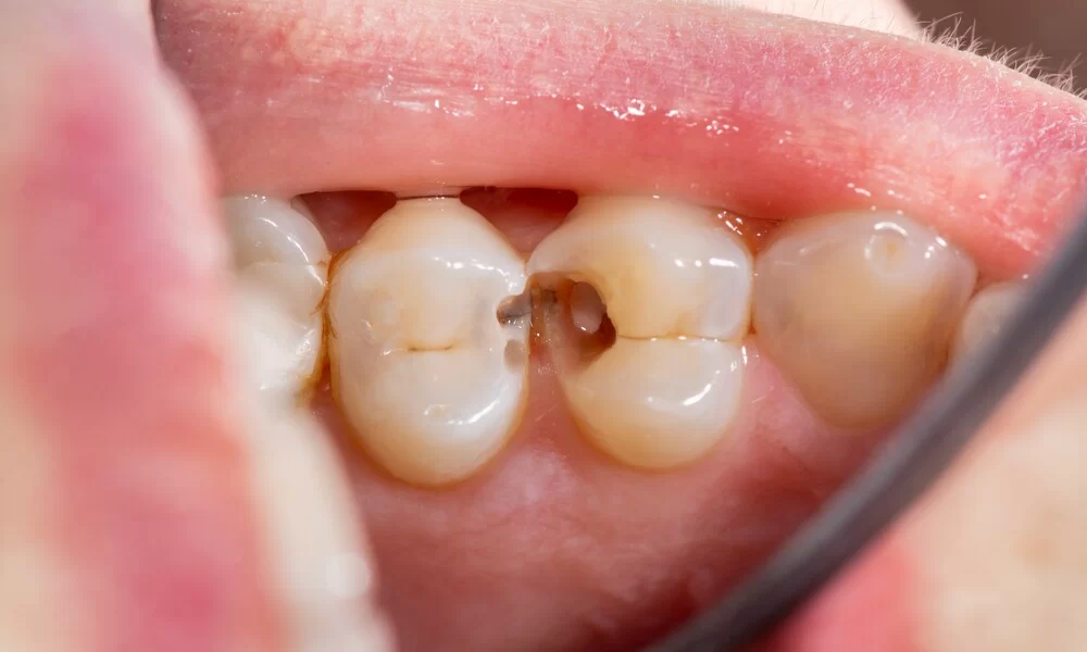 Causes of Cavities in Baby Teeth and How to Treat Them Effectively