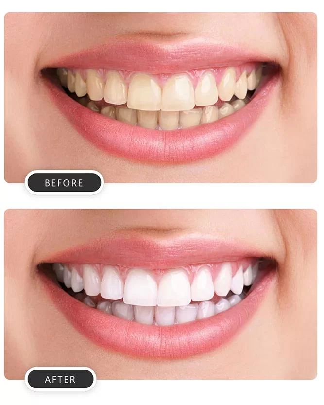 What Causes Tooth Discoloration and How to Treat It: Your Complete Guide to Whitening Solutions