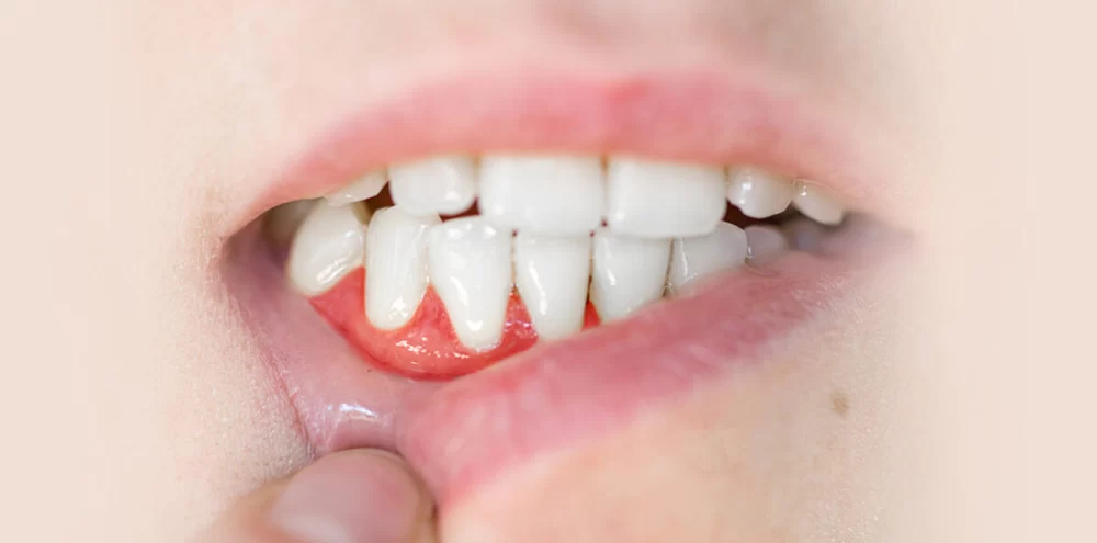 How to Reduce Gum Swelling from Tooth Disease: Effective Treatments and Tips