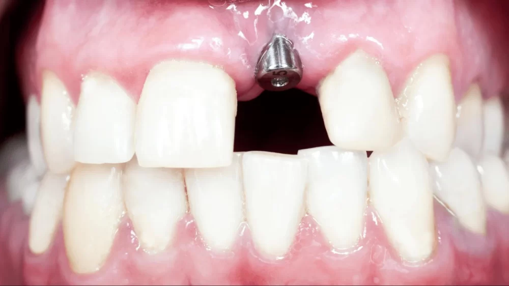 Restoring Missing Teeth with Dental Implants: A Comprehensive Guide