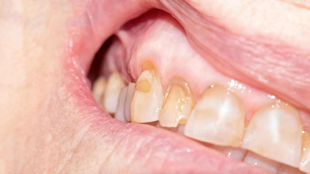 Prevention and Treatment of Tooth Enamel Erosion: Essential Tips for Stronger Teeth