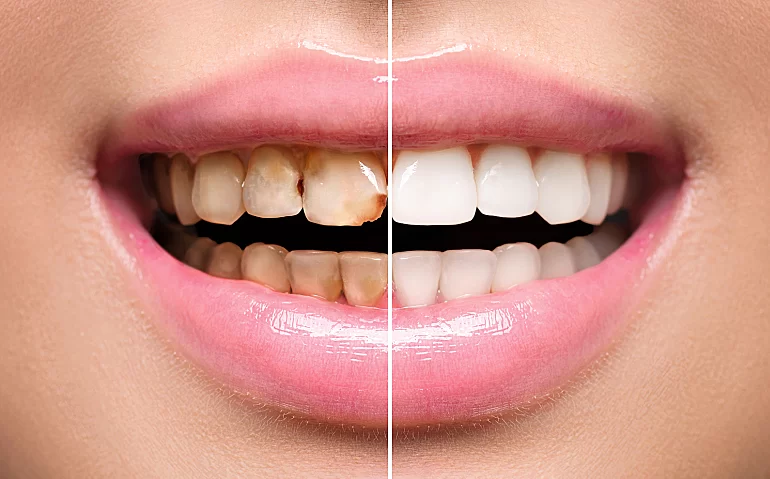 How to Reverse Gum Disease Before It Gets Serious: Early Treatment and Prevention