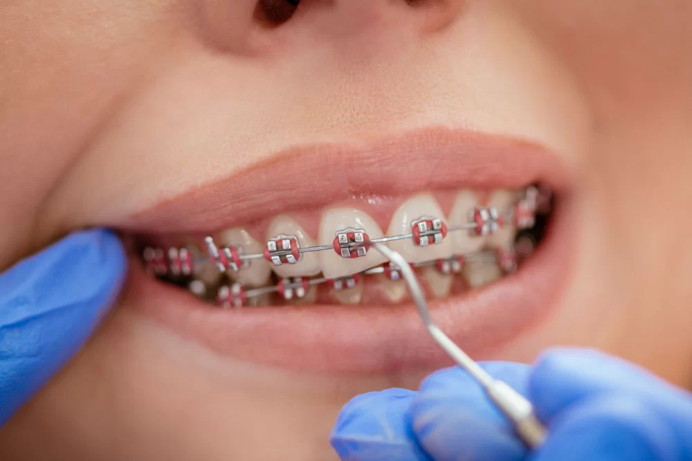 How Dental Insurance Works for Orthodontics: A Guide to Coverage and Benefits
