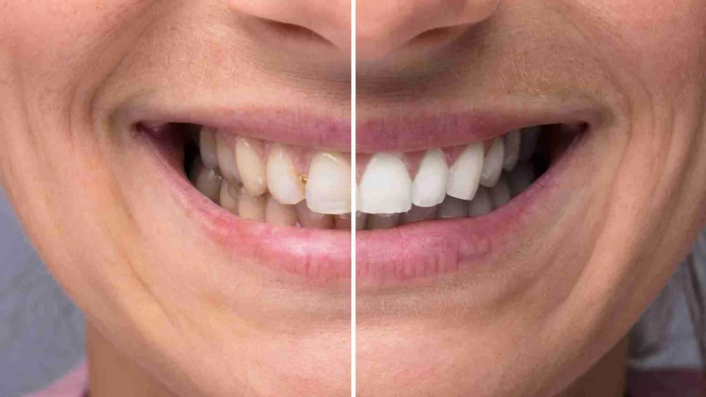 The Benefits of Regular Professional Teeth Whitening: Why It’s Worth It