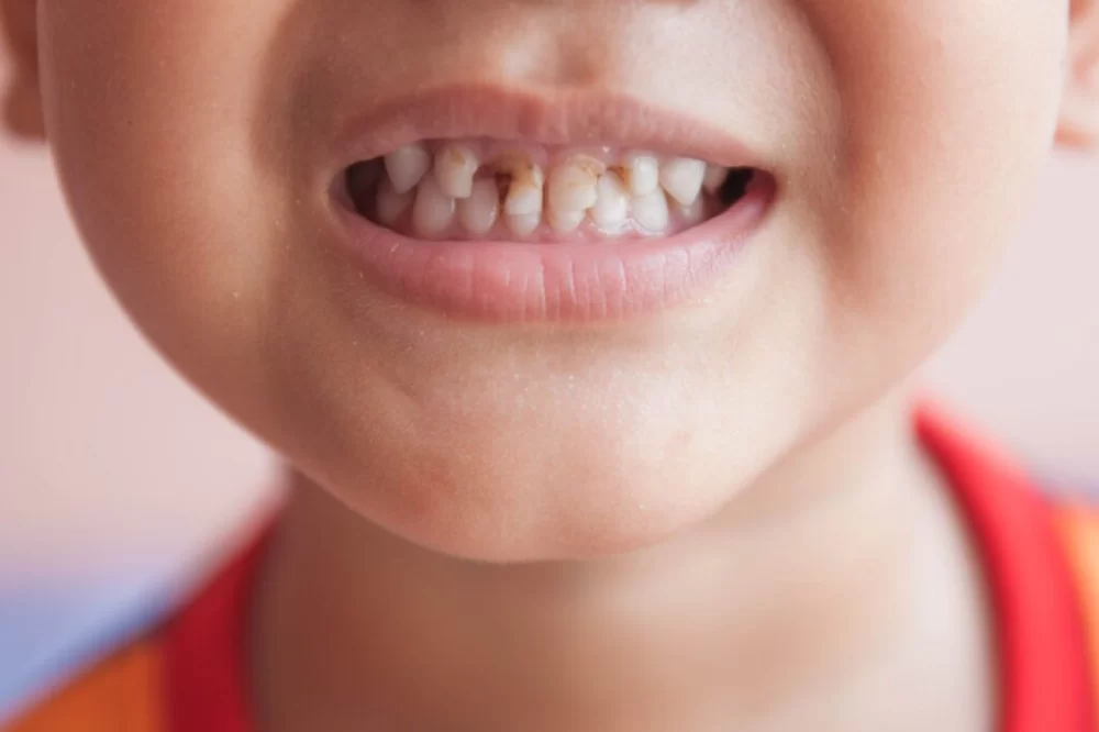 How to Prevent Early Childhood Tooth Decay: Essential Tips for Parents