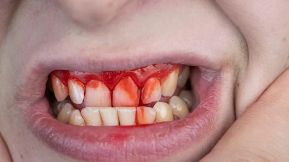 How to Stop Dental Bleeding After an Injury: Quick and Effective Solutions